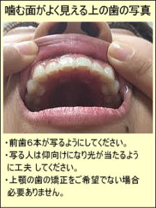 噛む面がよく見える上の歯の写真