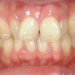 前歯のデコボコを簡単に治す！症例の徹底解説！！