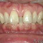 前歯のすきっ歯を簡単に治す！！