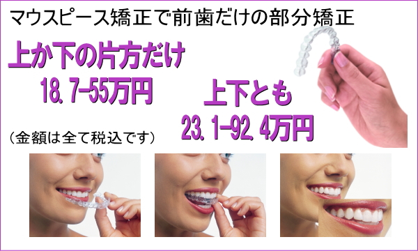 マウスピース矯正で前歯だけの部分矯正