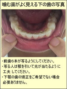 噛む面がよく見える下の歯の写真