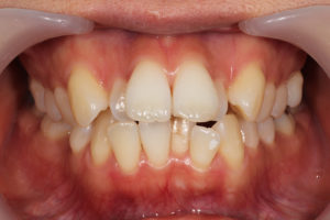 前歯が重度のデコボコ